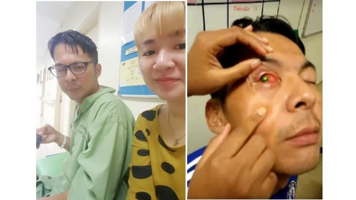 Mata Pria Ini Infeksi, Setelah Ke Dokter Umum Malah Jadi Buta, Penyebabnya Hal Sepele
