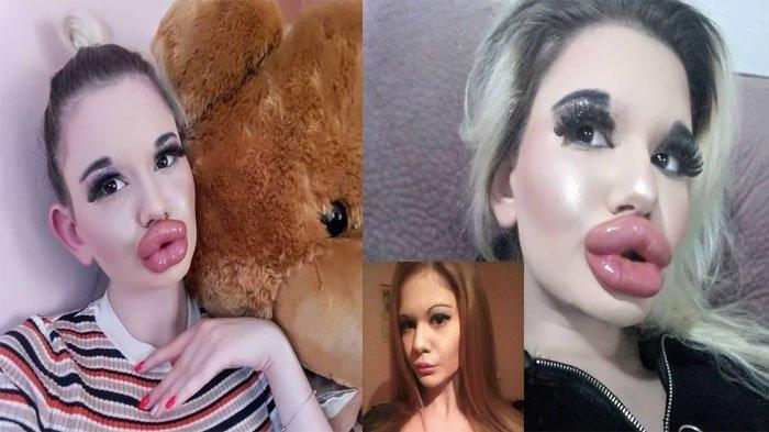 DEMI Punya Bibir Terbesar di Dunia, Wanita Ini Abaikan Peringatan Dokter: Belum Ada Efek Sampingnya