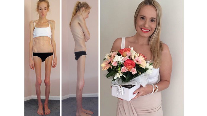 Anoreksiya yalangoch fotosuratlar