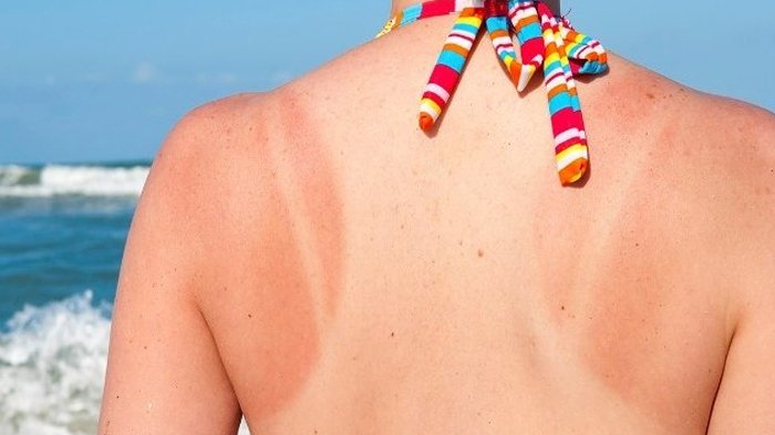 Jangan Ditutupi Pakai Make Up, Lakukan 7 Hal Ini Saat Kulitmu Terbakar Sinar Matahari