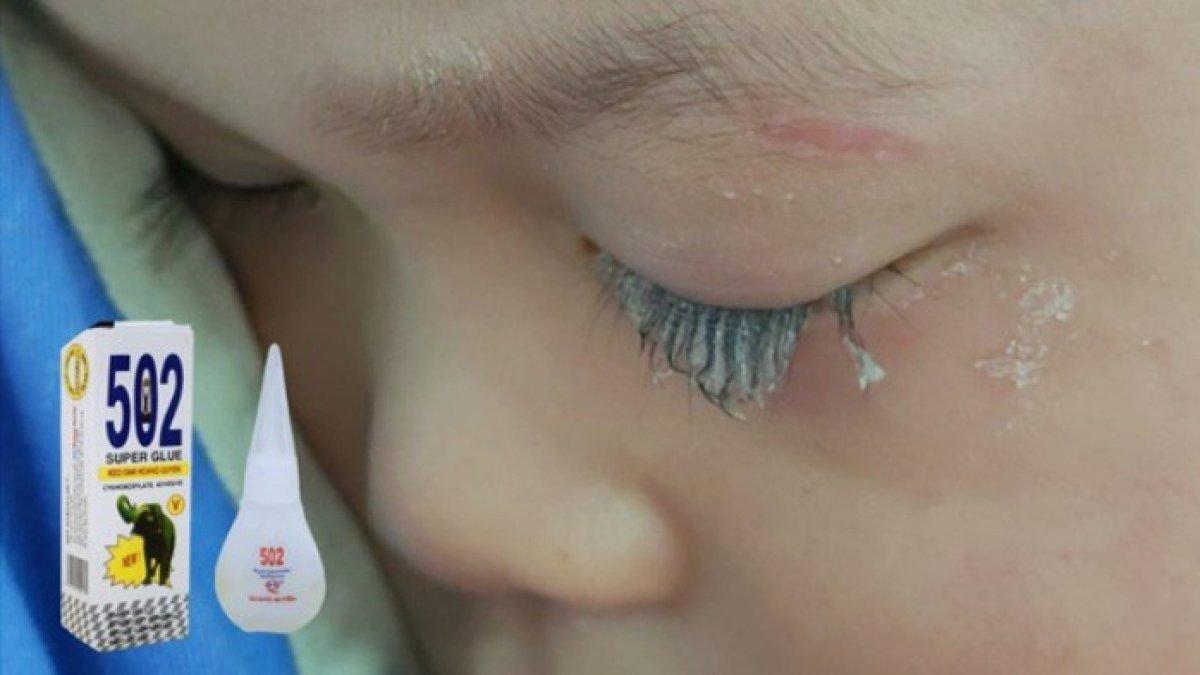 Mata Anak Nyaris Buta Gegara Kena Lem Super, Reaksi Ayah Dipuji Dokter: Kamu yang Menyelamatkannya