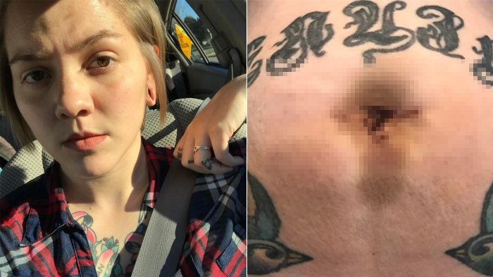 Setelah Melahirkan secara Caesar, Luka Mengerikan Muncul di Perut Ibu Ini, Dokter Kaget Bukan Main!