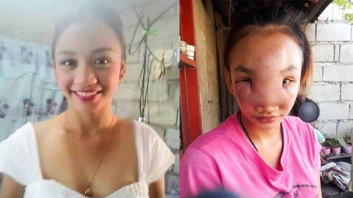 AKIBAT Pencet Jerawat Berujung Petaka, Wajah Ibu Muda ini Membengkak Hingga Buat Mata Kanan Buta