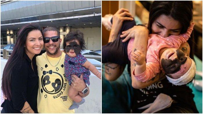 Operasi Sukses Bayi Bertanda Lahir Seperti Batman, Habiskan Rp 350 Juta & Kelangkaan Kondisinya