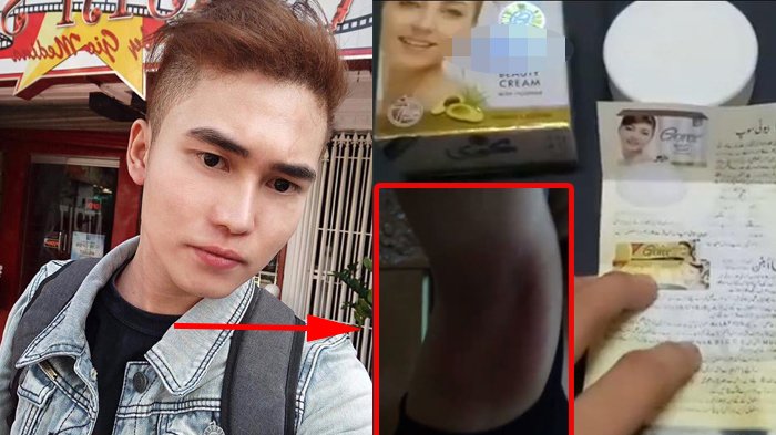Viral Cowok Bagi Pengalaman Adiknya Pakai Krim Pemutih di Ketiak, Pingin Jadi Cerah, Akhirnya Ngeri