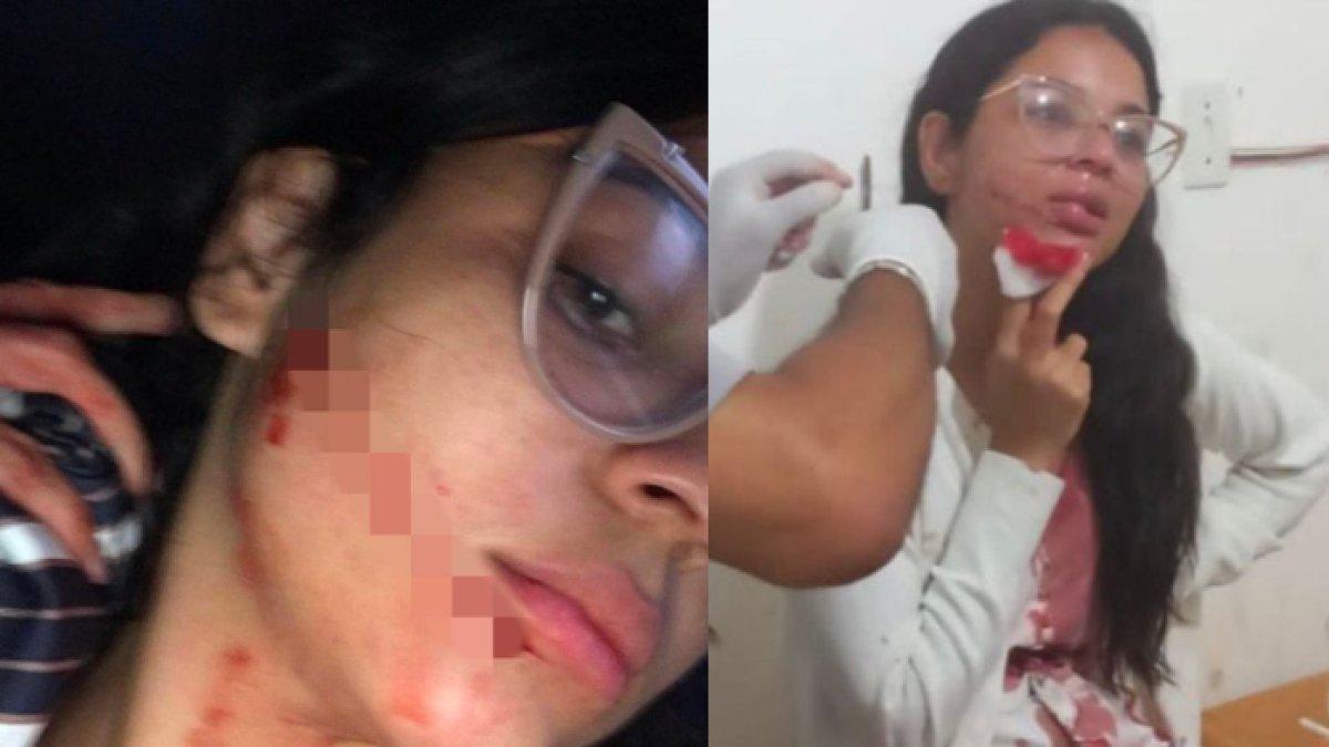 Ketiduran di Bus, Selebgram Cantik Terbangun dengan Pipi Berdarah, Sebabkan Bekas Luka Seperti Joker