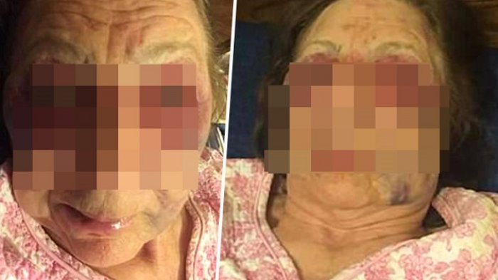 Sehari Menjelang Pemakaman Suaminya, Nenek Ini Babak Belur Dihajar Maling, Kondisinya Miris!