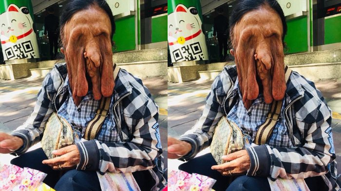 Idap Penyakit Langka, Wajah Nenek Ini Terlihat Seperti Meleleh!