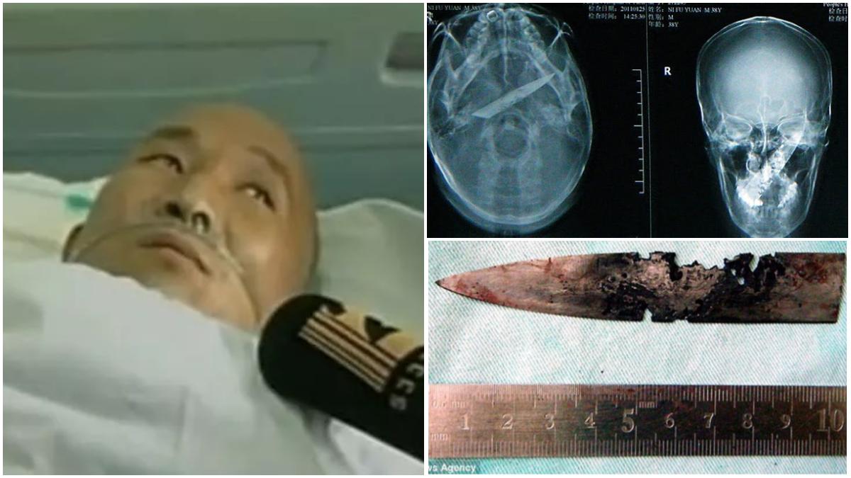 Pria Ngaku 4 Tahun Pusing, Ahli Bedah Syok Saat Melihat Ada Pisau Karatan Menancap di Dalam Kepala