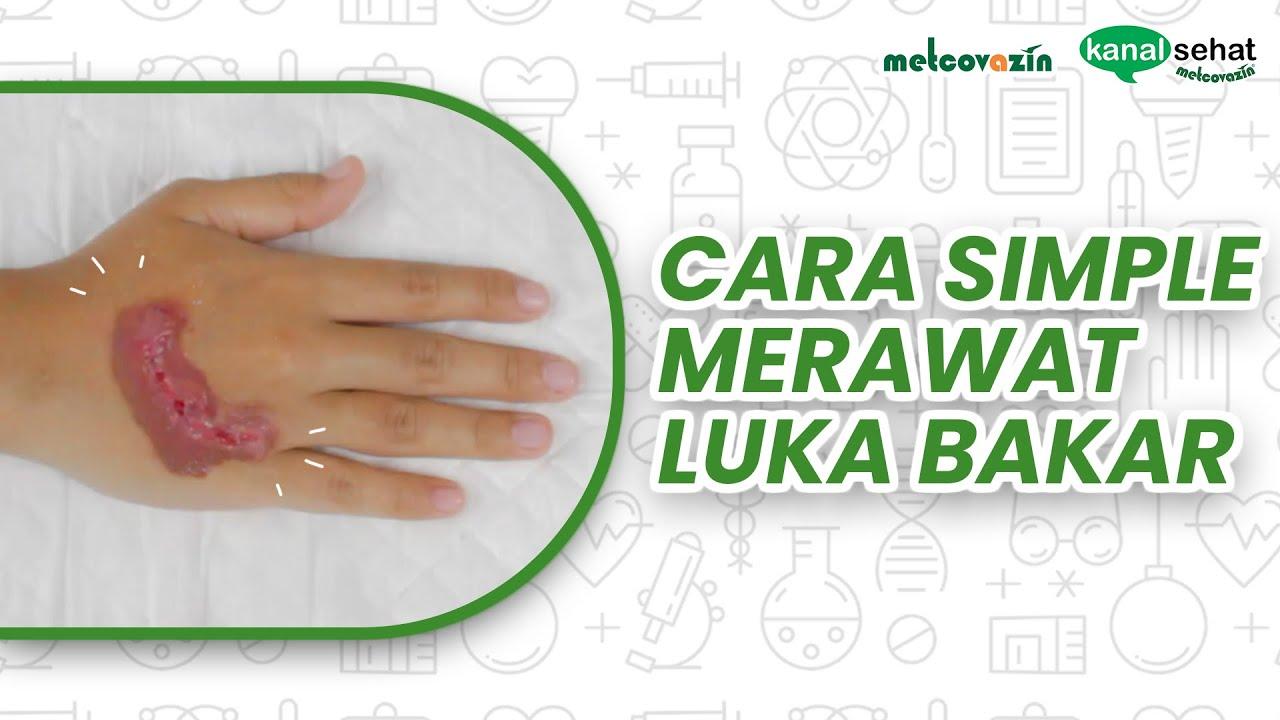 atasi-luka-bakar-dengan-mudah.jpg