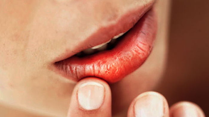 Waspada! Bibir Kering dan Pecah-pecah Ternyata Bisa Jadi Pertanda 8 Penyakit Ini