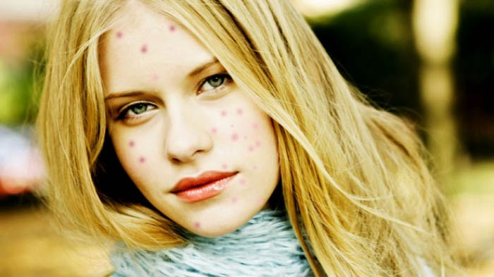 Kamu Punya Bekas Cacar Air yang Mengganggu? Atasi dengan 9 Bahan Alami Ini