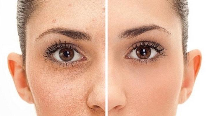 Cara Menghilangkan Flek Hitam di Wajah Menggunakan Jahe, Hanya Butuh Waktu Kurang dari 30 Menit!