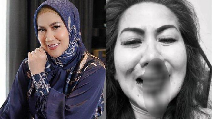 foto-venna-melinda-setelah-jadi-korban-kdrt.jpg