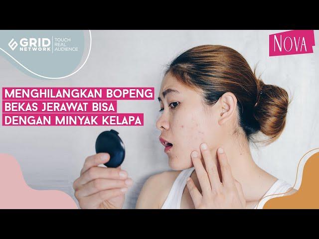 hilangkan-bopeng-dengan-minyak-kelapa.jpg