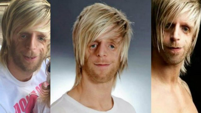 Pria Ini Di-bully dan Diabaikan Keluarga Sendiri Karena Cacat Fisik, Namun Rencana Tuhan Lebih Indah