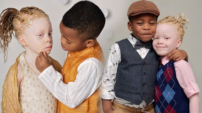 POPULER Kisah Dua Anak Kembar Tapi Beda, Dokter Sempat Khawatir, Kini Tumbuh Normal dan Penuh Kasih