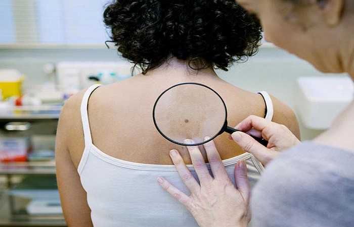 Sering Disepelekan, 7 Gejala Kanker Kulit Ini Tak Bisa Dilihat dengan Mata Telanjang