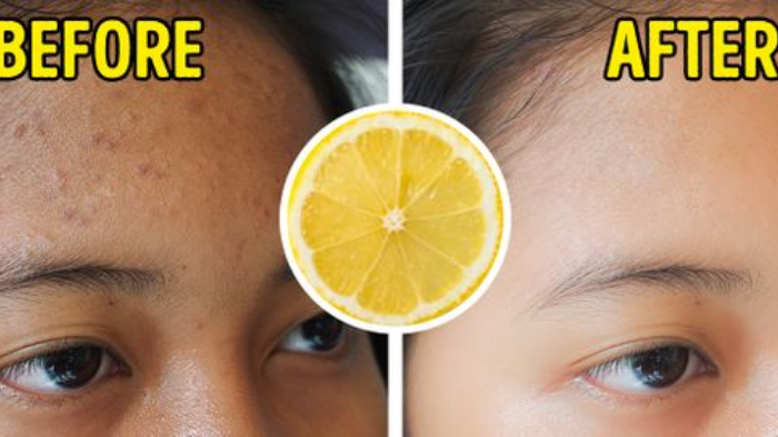 7 Makanan yang Dapat Mengurangi Luka Bekas Jerawat, Labu Hingga Quinoa