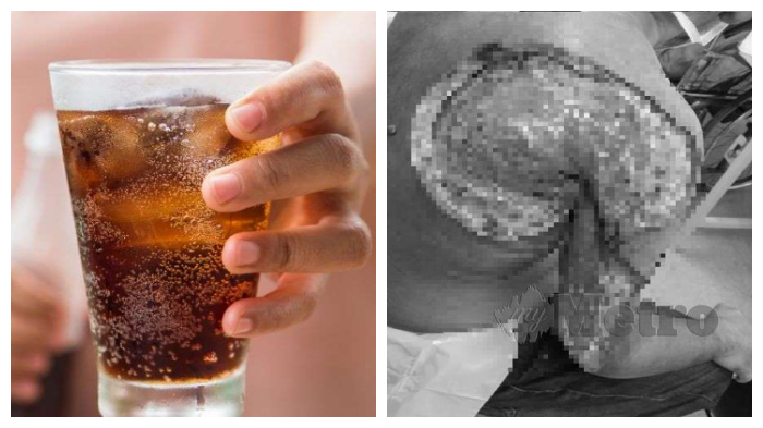 Minum 2 Kaleng Soda Setiap Hari, Pria Ini Hampir Kehilangan Tangannya Berawal dari Bisul di Punggung