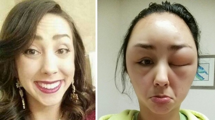 Awas! Gunakan Pewarna Rambut, Wajah Wanita Ini Malah Berubah Jadi Mengerikan!