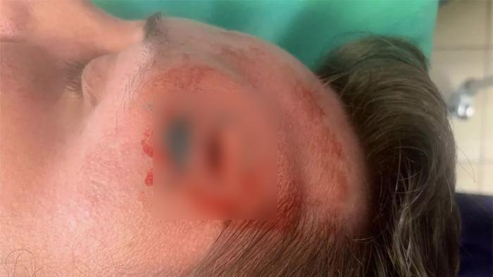 NGERI Dikira Sakit Kulit, Ternyata Ada Cacing 15 Cm Bersarang di Dahi Pria Ini, Darah Bercucuran