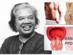 arswendo-meninggal-kanker-prostat.jpg