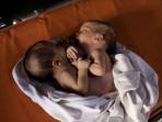 bayi-kembar-siam_20160828_214426.jpg