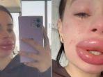 bibir-jessica-burko-bengkak-hebat-setelah-melakukan-operasi-filler-bibir-gratis-2.jpg