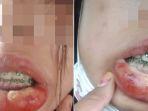 bibir-jontor-lantaran-kawat-gigi.jpg