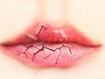 bibir-pecah-foto.jpg