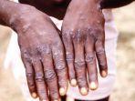 cacar-monyet-atau-monkeypox-1.jpg