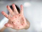cacar-monyet-atau-monkeypox-2572022.jpg