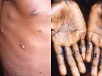 cacar-monyet-atau-monkeypox.jpg