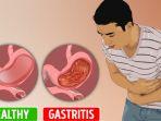 gastritis.jpg