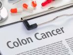 kanker-usus-besar_20161118_190315.jpg