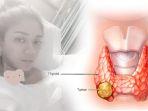 thalita-latief-kiri-ilustrasi-tumor-tiroid-kanan-123.jpg