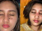 usai-jalani-oplas-hidung-anak-youtuber-farida-nurhan-bengkak-hingga-alami-infeksi.jpg