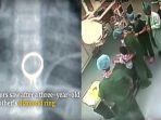 video-viral-anak-kecil-ini-telan-cincin-berlian-milik-ibunya-berakhir-di-meja-operasi-2.jpg