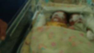 Bayi-kembar-siam-asal-Mamuju-yang-kini-dirawat-fdi-RS-Wahidin-Sudirohusodo-Makassar.jpg