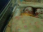 Bayi-kembar-siam-asal-Mamuju-yang-kini-dirawat-fdi-RS-Wahidin-Sudirohusodo-Makassar.jpg