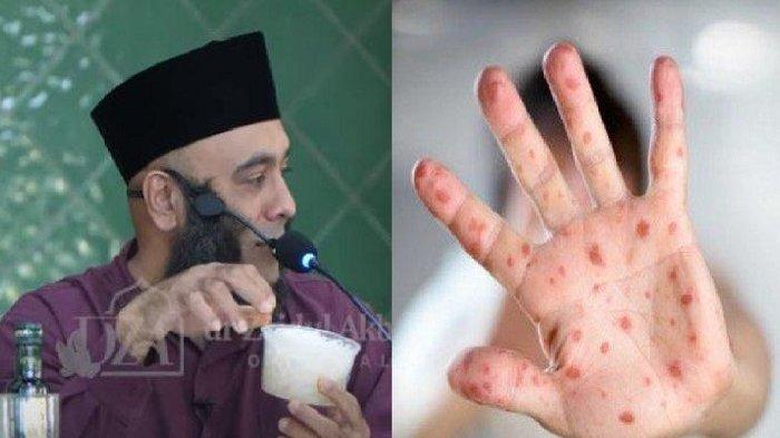 Hati-hati Proses Penularan Cacar Air, Cegah Sebelum Terlambat, Begini Cara dr Zaidul Akbar