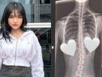 mengenal-skoliosis-penyakit-yang-dialami-selebgram-Fujianti-Utami-Putri.jpg