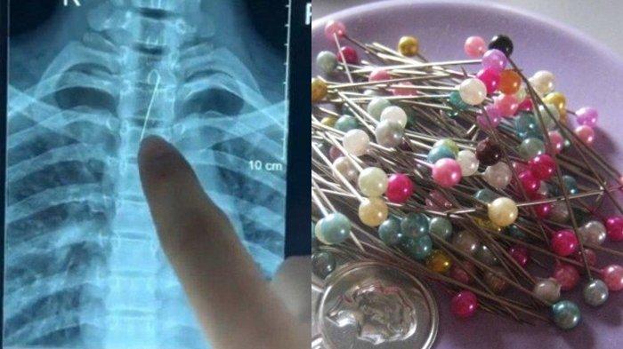 Kisah Wanita di Jombang Tertelan Jarum Pentul Saat Pasang Hijab, Nyangkut di Trakea Harus Operasi