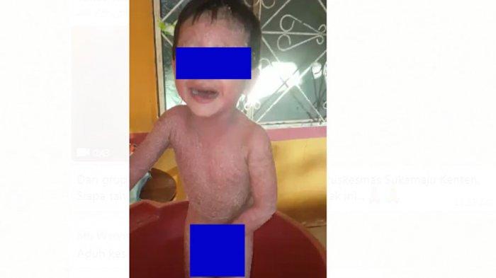 Viral Video Memilukan Anak Sakit Kulit Parah, Ini Hasil Penelusuran Tribunsumsel.com