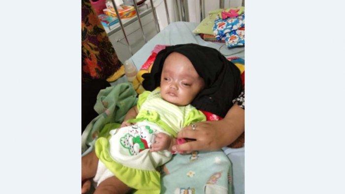 Tak Punya Biaya, Asyila Bayi Penderita Hidrocepalus Terpaksa Dirawat di Rumah