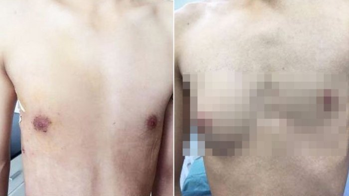 Gara-gara Terlalu Sering Makan Makanan Cepat Saji, Lihat yang Terjadi Pada Dada Pria Ini