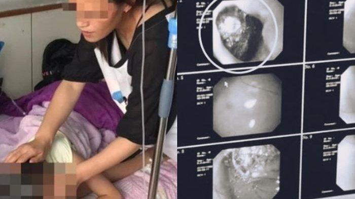 Ibu Kaget Saat Lihat Gumpalan Berdiameter 18 Sentimeter di Perut Anak 9 Tahunnya, Ternyata Makan Ini