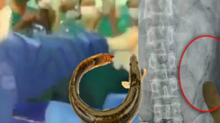 Pria Ini Nekat Taruh 2 Ikan dalam Lubang Anusnya Demi Kenikmatan Sesaat, Malah Ini yang Terjadi