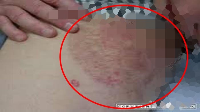 Kesal Selangkangan Hitam Berbintik dan Bau, Tenang Ini Cara Mudah dan Murah Memutihkannya